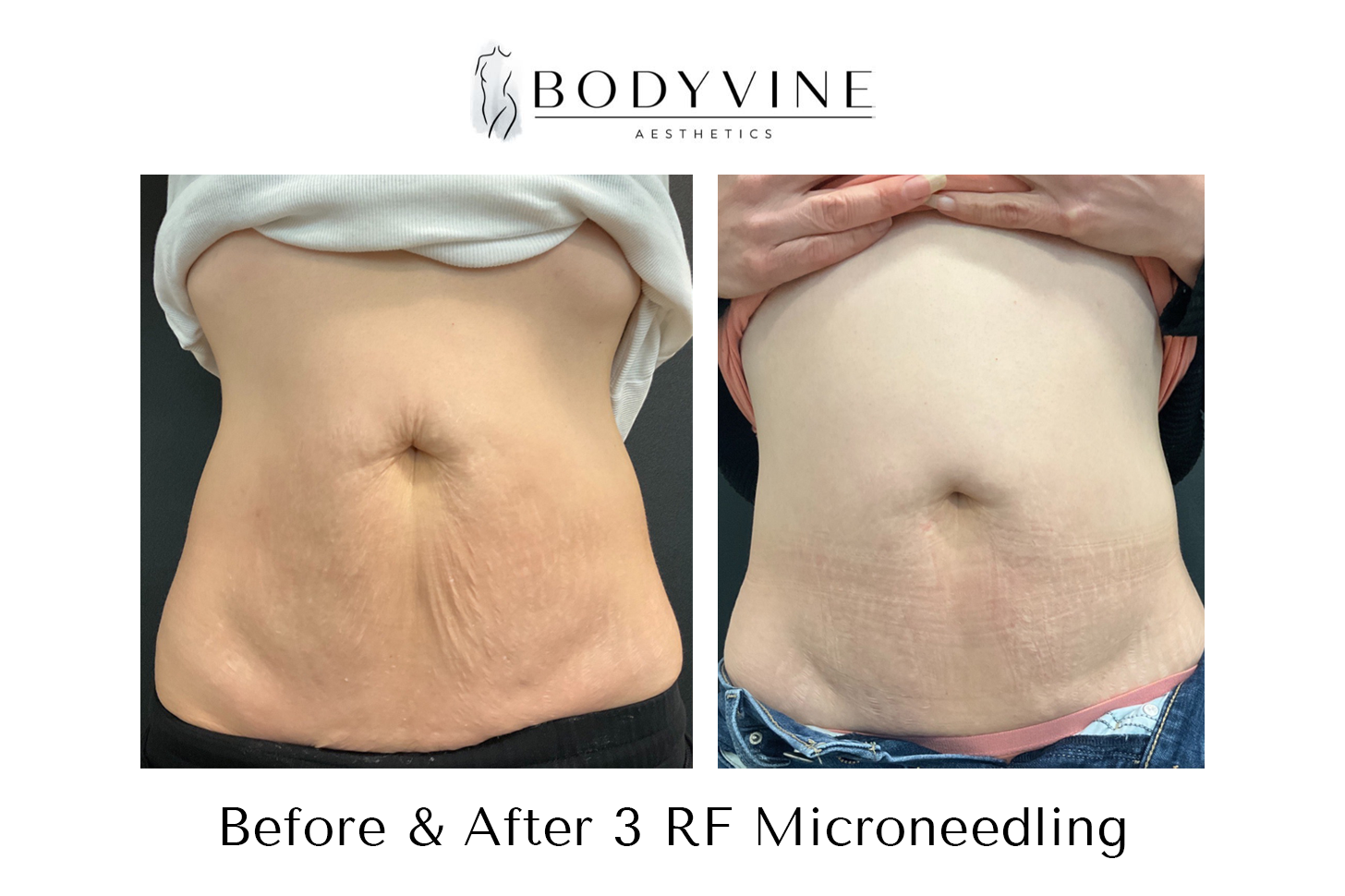 Cellulite_reduction_and_skin_tightening_before_and_after_01