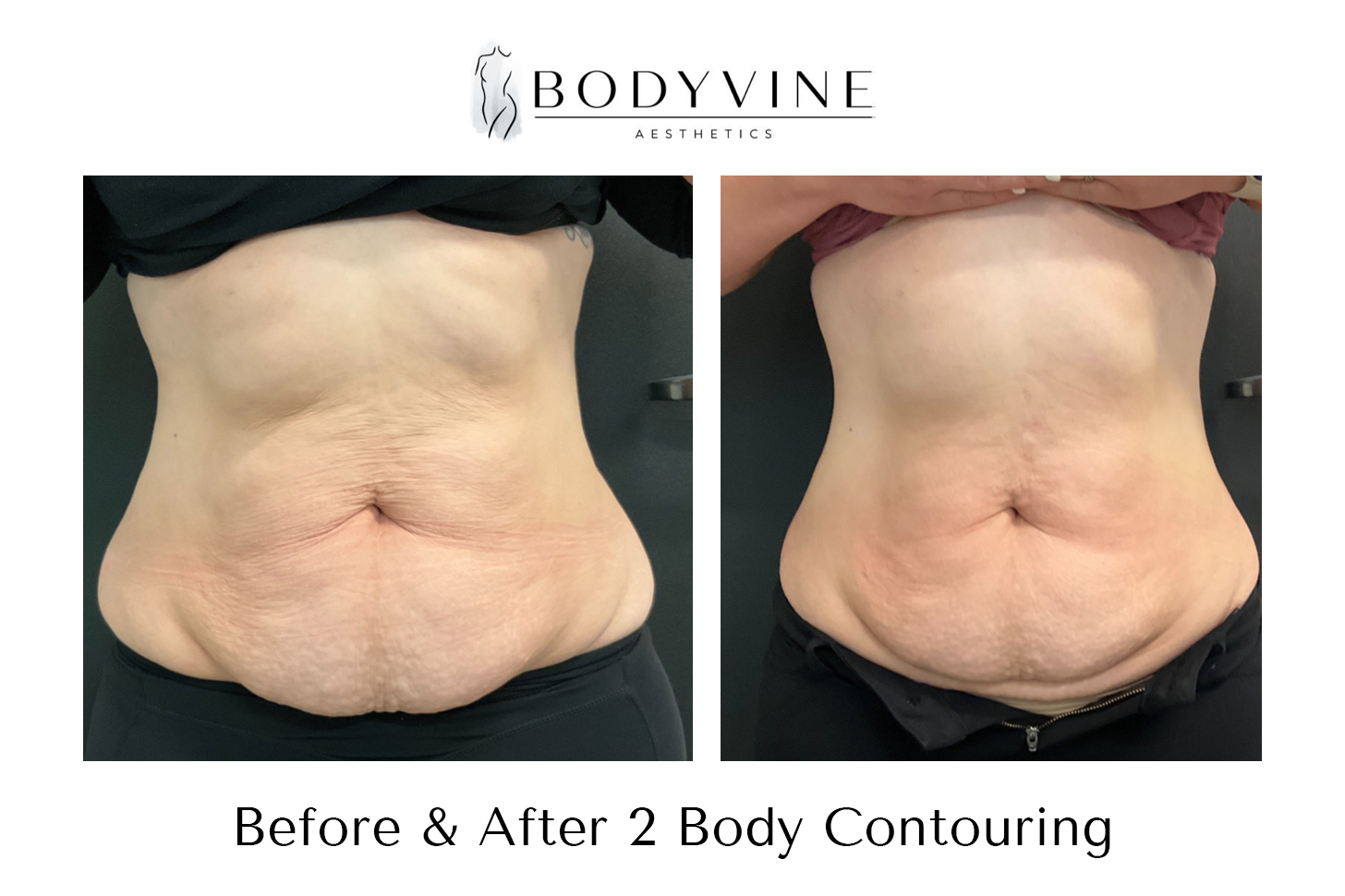 Cellulite_reduction_and_skin_tightening_before_and_after_02