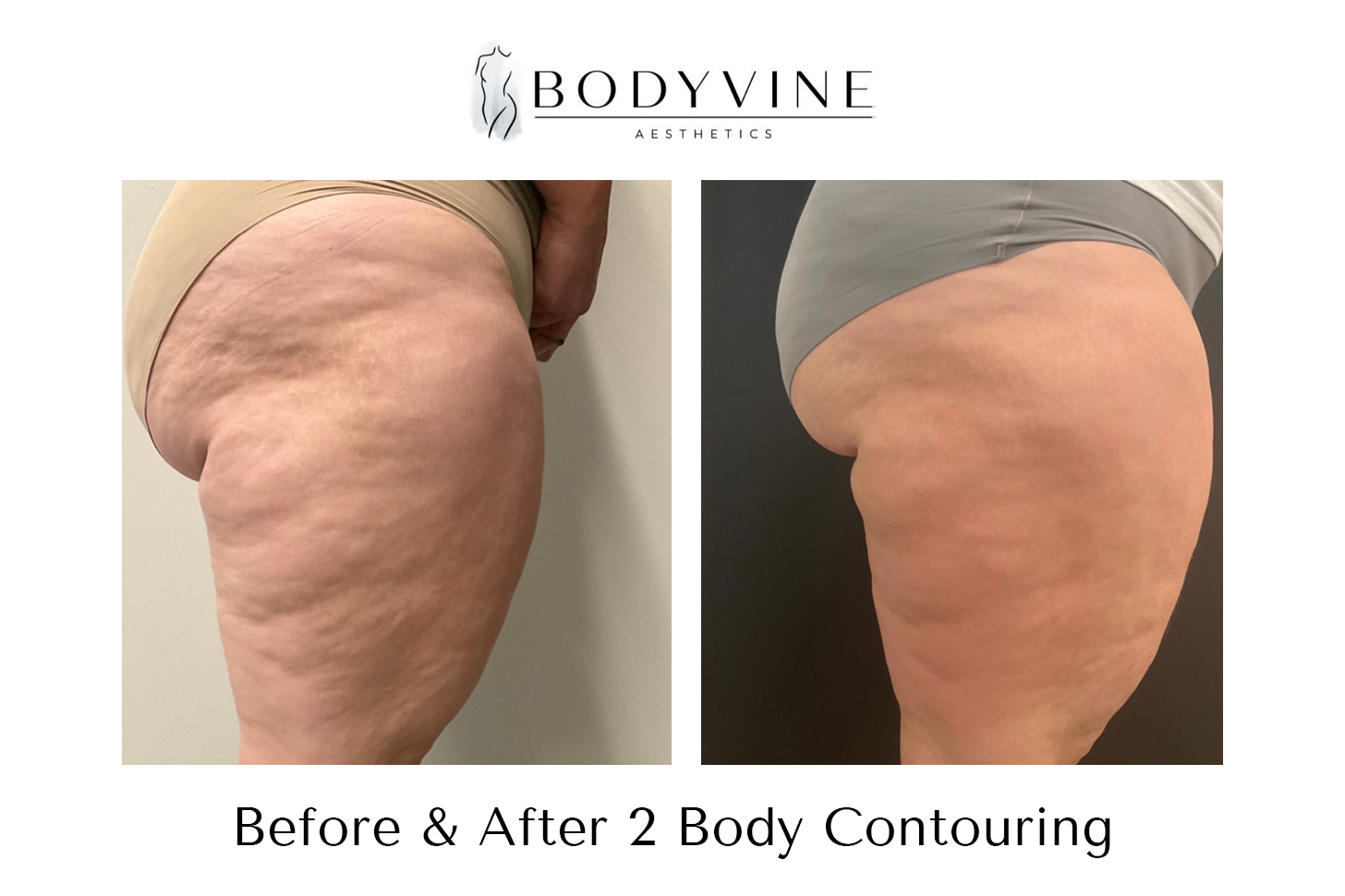 Cellulite_reduction_and_skin_tightening_before_and_after_03