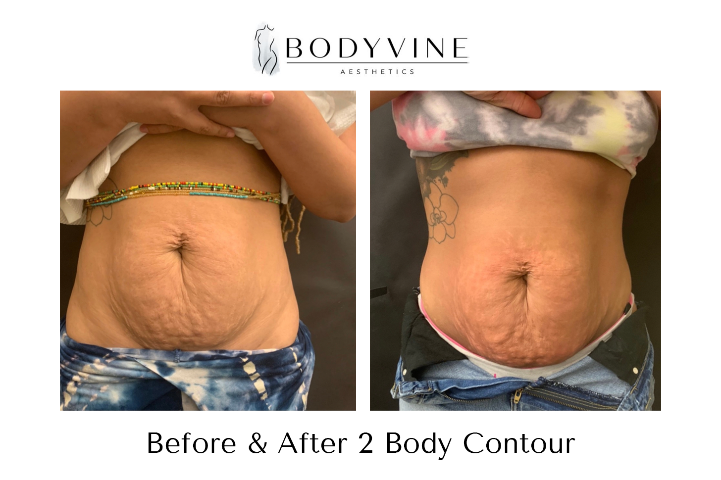 Cellulite_reduction_and_skin_tightening_before_and_after_04
