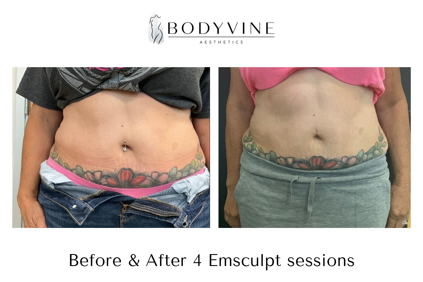 Emsculpt_before_and_after_01