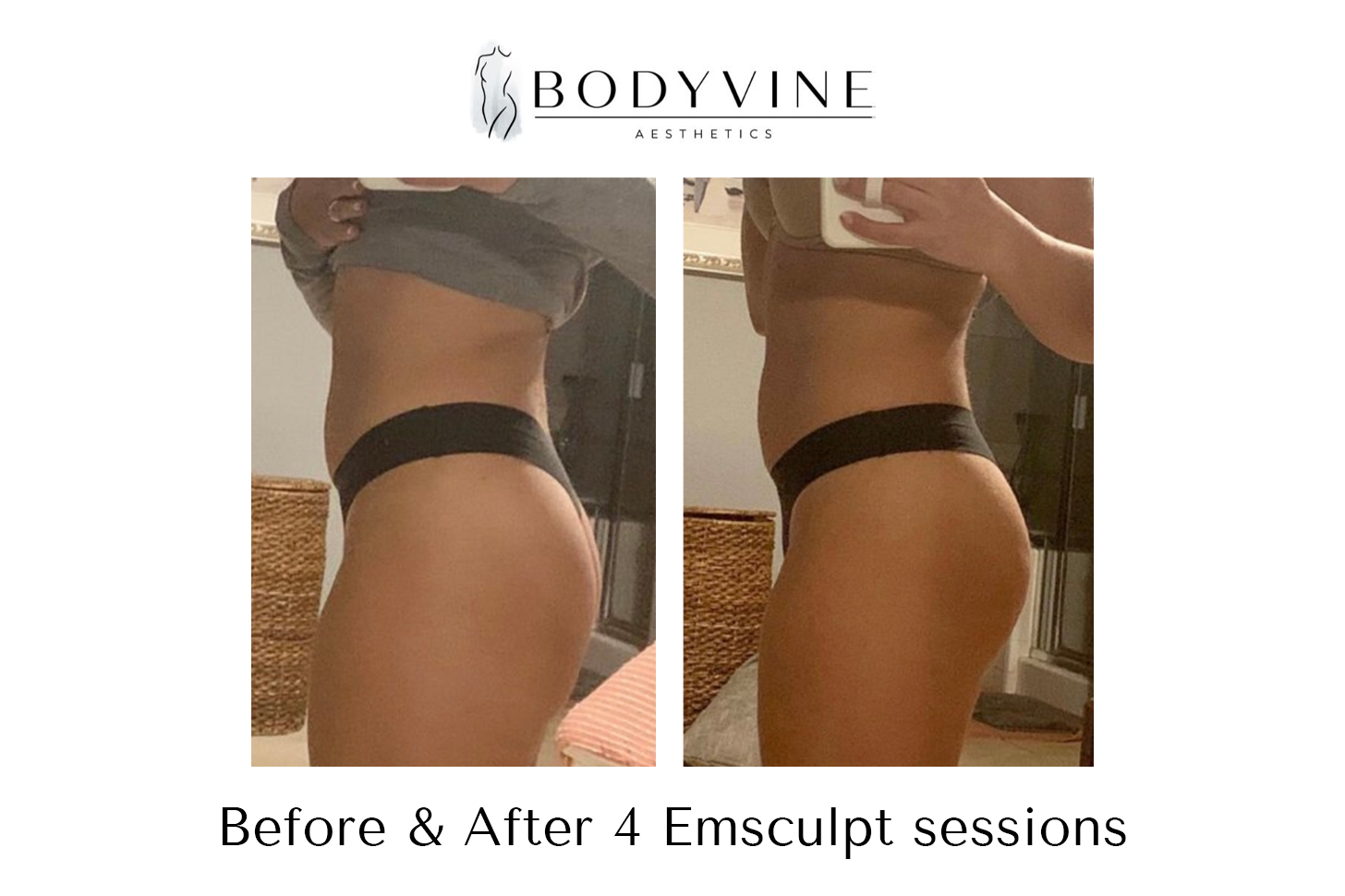 Emsculpt_before_and_after_02