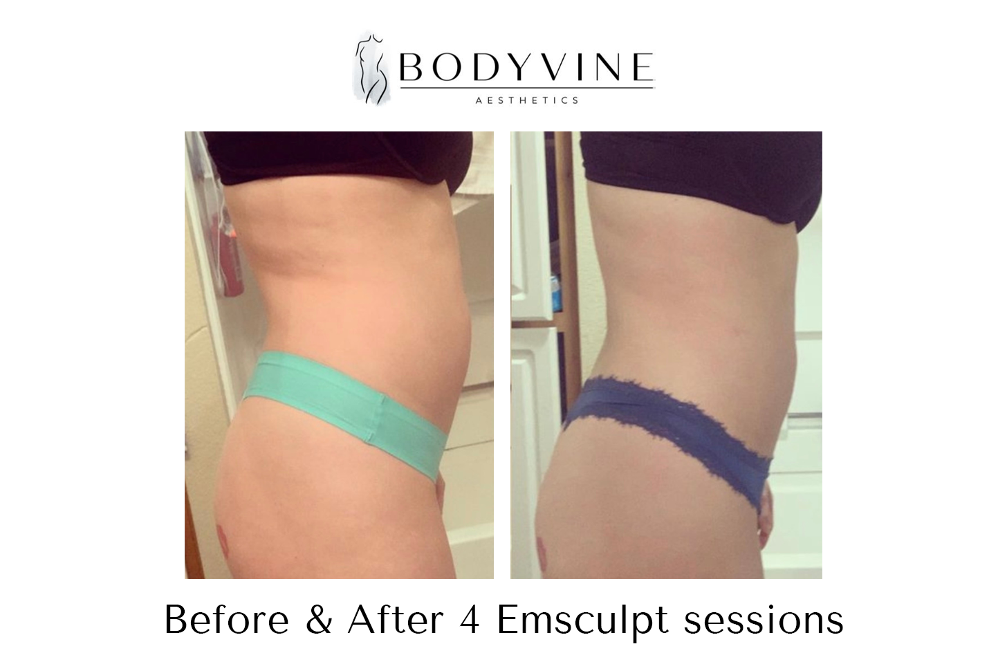 Emsculpt_before_and_after_03