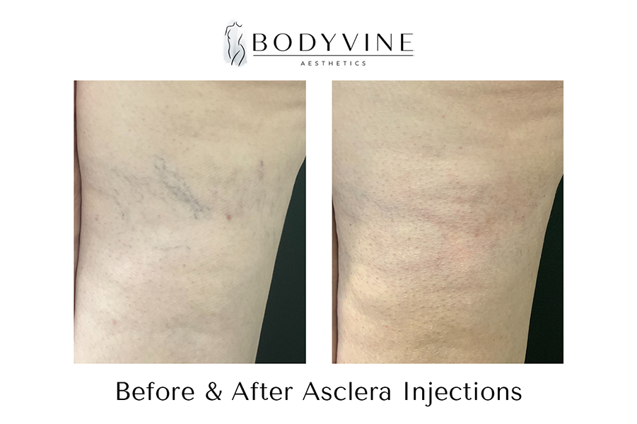Injectables_before_and_after_15