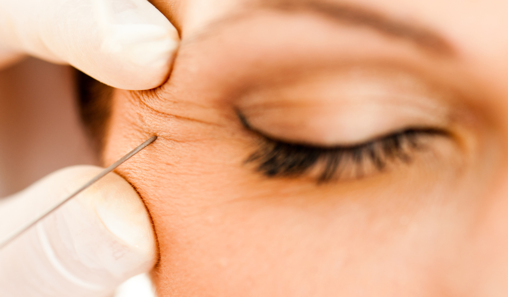 botox treatment areas