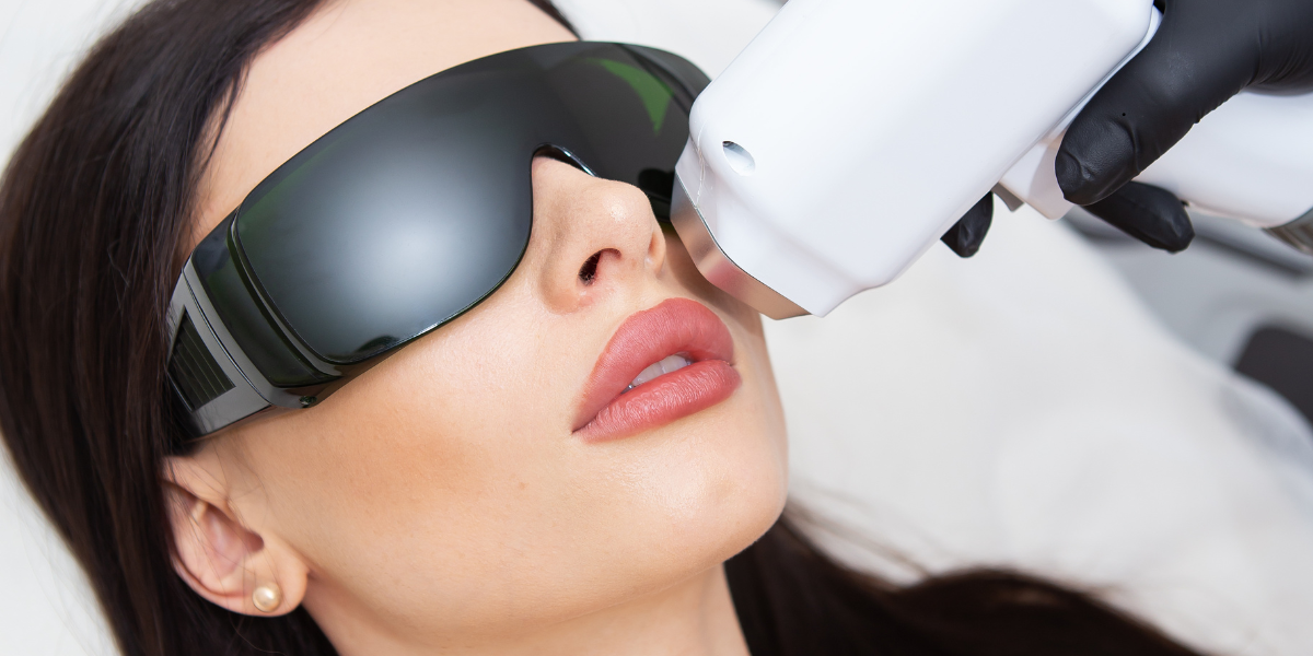 face laser hair removal