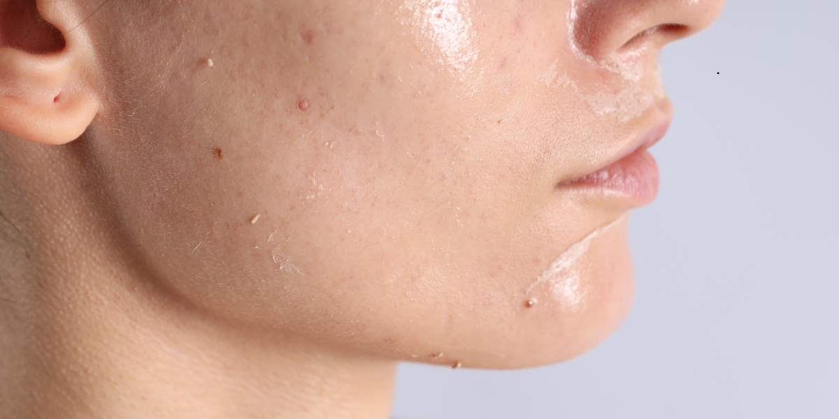 What Laser Skin Resurfacing Can Treat