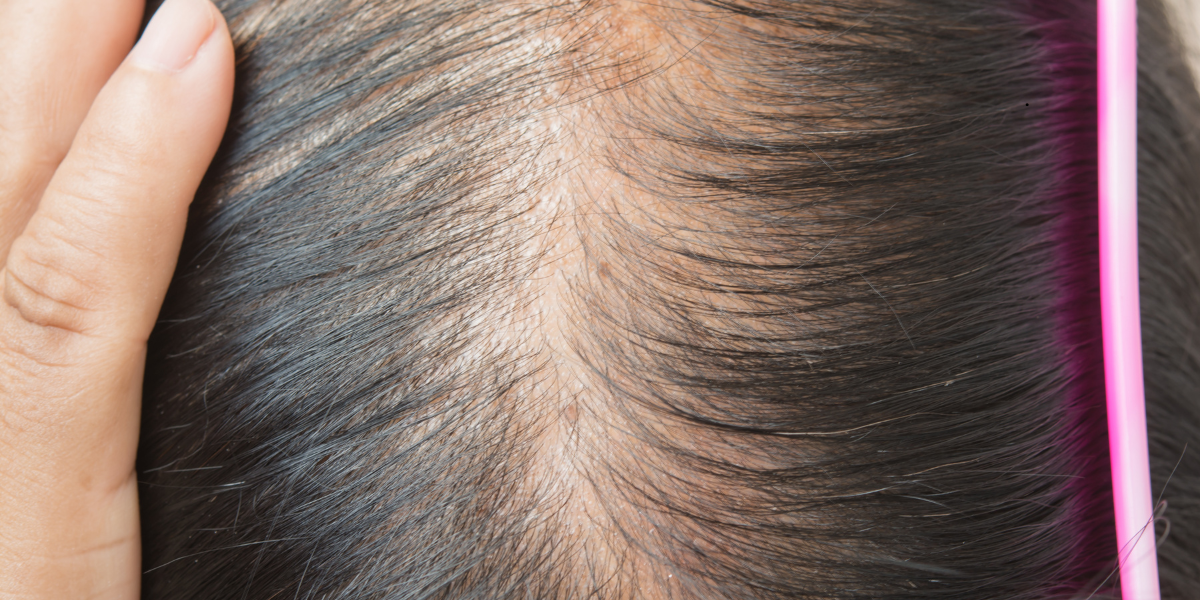 Begin your hair restoration consultation at Bodyvine Aesthetics