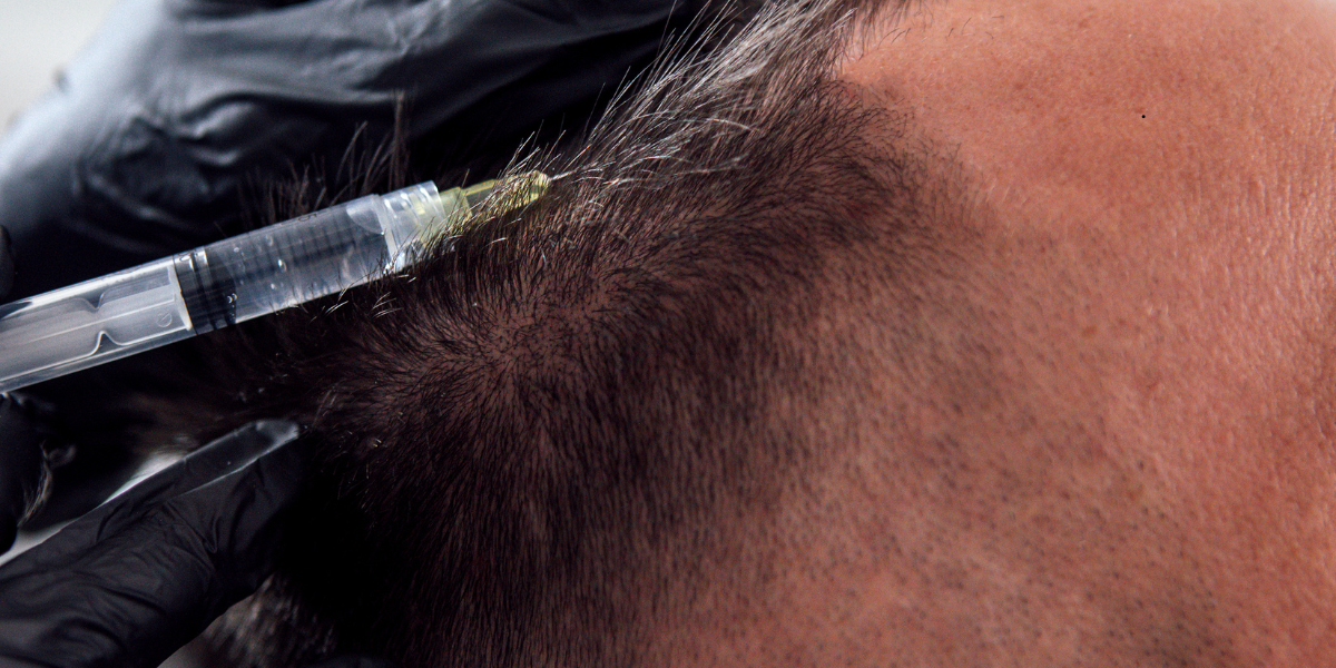 Hair Restoration in Roseville CA