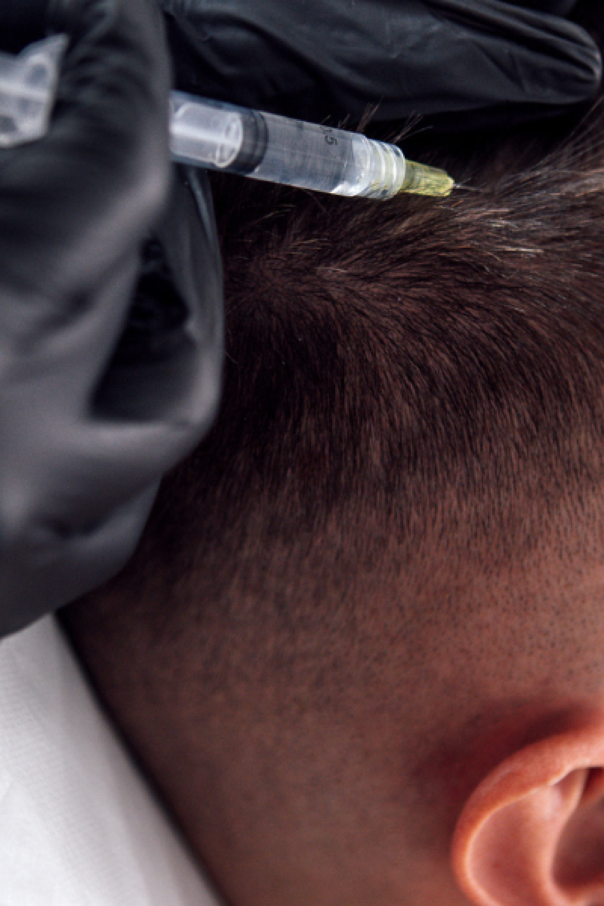 What platelet-rich plasma therapy is and how it supports hair regrowth