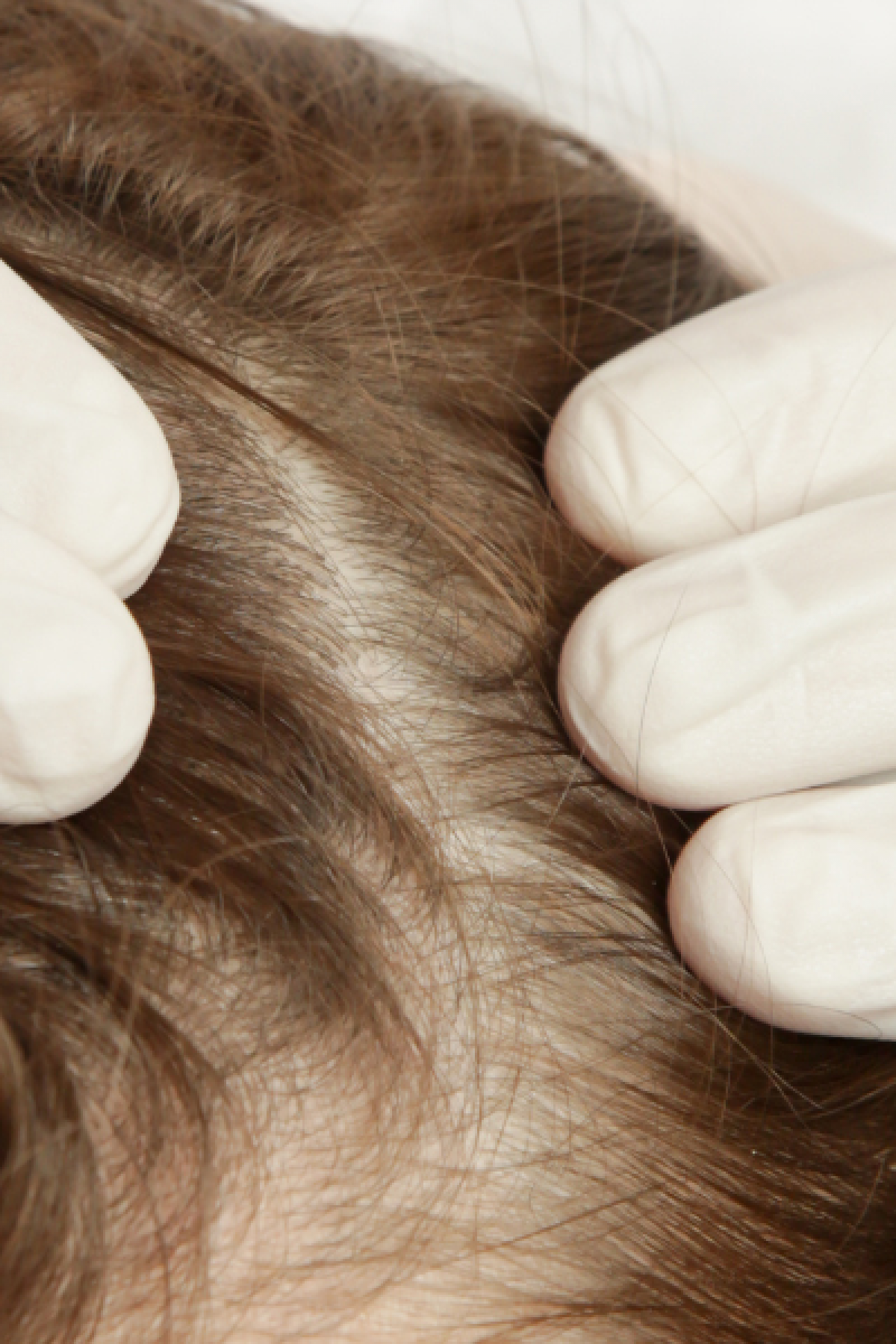 Your hair restoration timeline and what realistic progress looks like